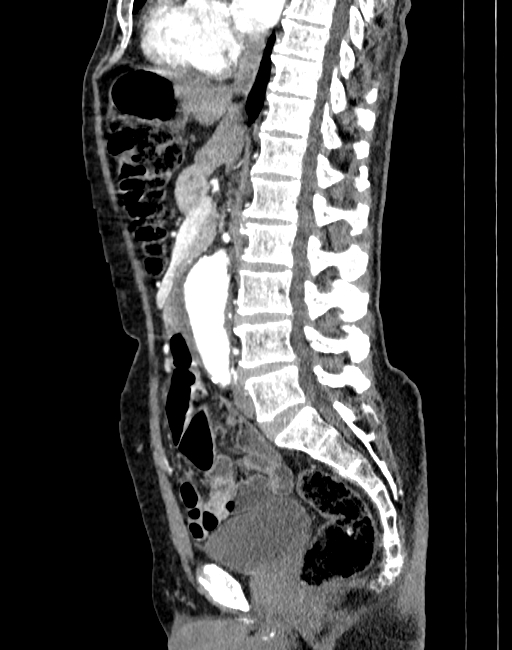 Abdominal aortic aneurysm (Radiopaedia 83581-98689 Sagittal C+ arterial phase 40).jpg