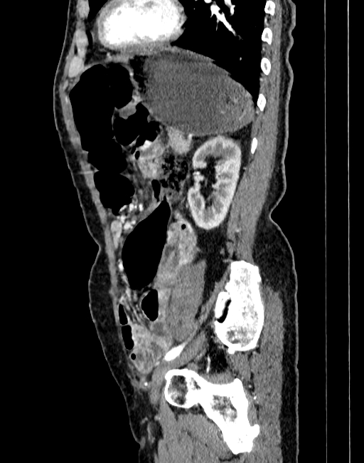 Abdominal aortic aneurysm (Radiopaedia 83581-98689 Sagittal C+ arterial phase 85).jpg