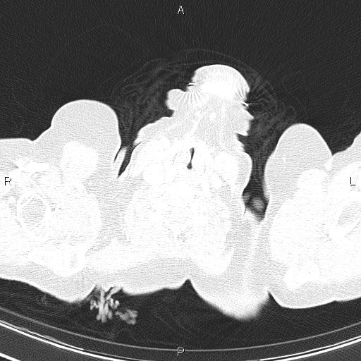 File:Abdominal aortic aneurysm (Radiopaedia 85063-100606 Axial lung window 2).jpg