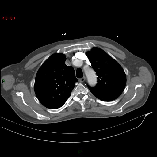 File:Abdominal aortic aneurysm rupture with aortocaval fistula (Radiopaedia 14897-14841 Axial C+ arterial phase 8).jpg