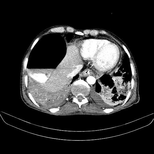 File:Abdominal collection due to previous cecal perforation (Radiopaedia 80831-94320 Axial C+ portal venous phase 20).jpg