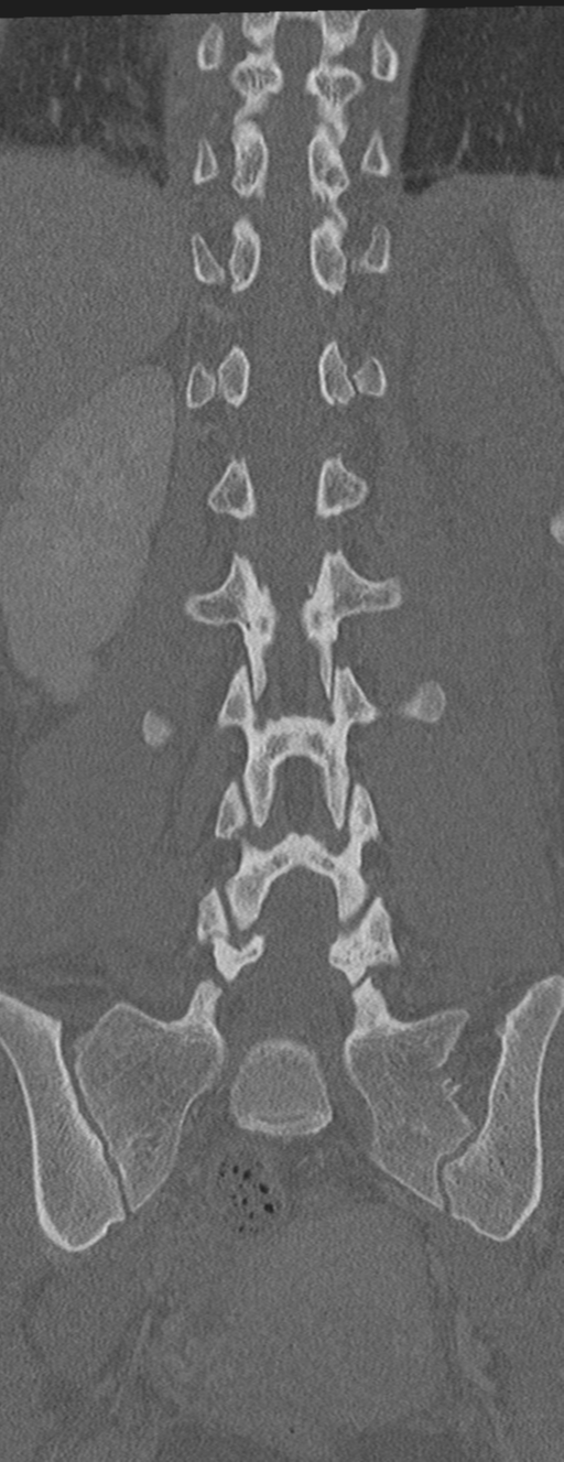Abdominal multi-trauma - devascularised kidney and liver, spleen and pancreatic lacerations (Radiopaedia 34984-36486 Coronal bone window 45).png