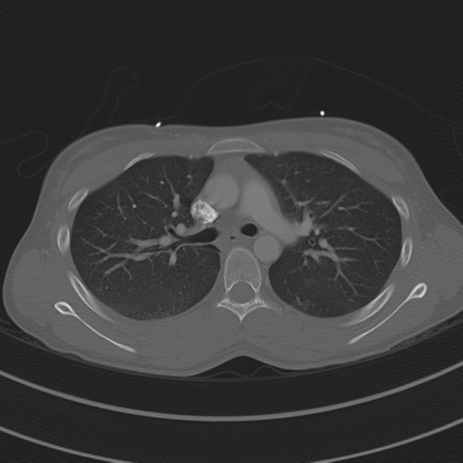 File:Abdominal multi-trauma - devascularised kidney and liver, spleen and pancreatic lacerations (Radiopaedia 34984-36486 I 33).png