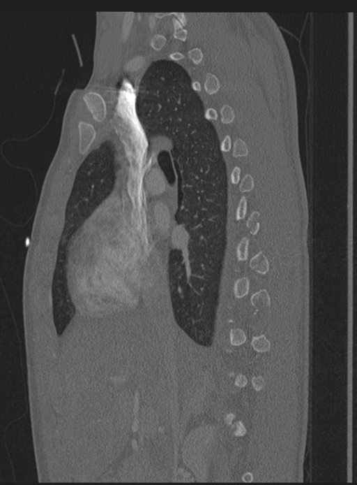 Abdominal multi-trauma - devascularised kidney and liver, spleen and pancreatic lacerations (Radiopaedia 34984-36486 Sagittal bone window 48).png