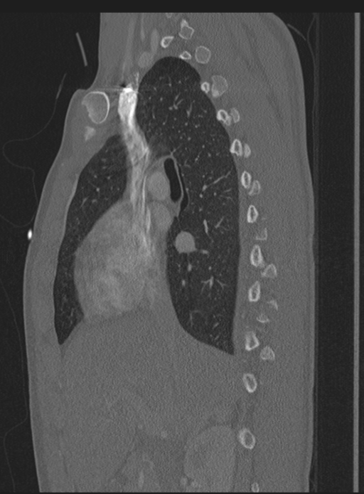 Abdominal multi-trauma - devascularised kidney and liver, spleen and pancreatic lacerations (Radiopaedia 34984-36486 Sagittal bone window 51).png