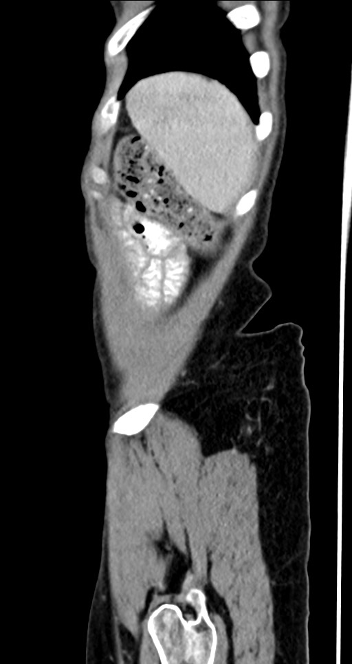 Abdominal wall and retroperitoneal tuberculosis (Radiopaedia 88137-104729 Sagittal C+ portal venous phase 20).jpg