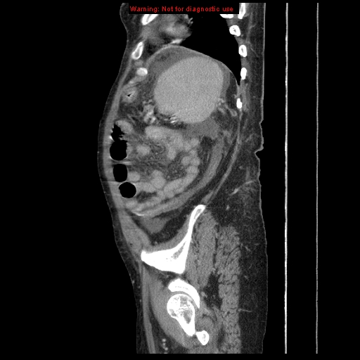 Abdominal wall hematoma (Radiopaedia 9427-10112 Sagittal C+ portal venous phase 22).jpg