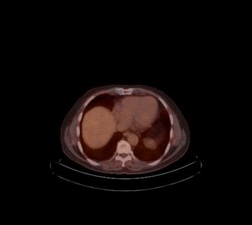 Abdominal wall metastasis from colorectal carcinoma (Radiopaedia 31016-31719 C 96).jpg