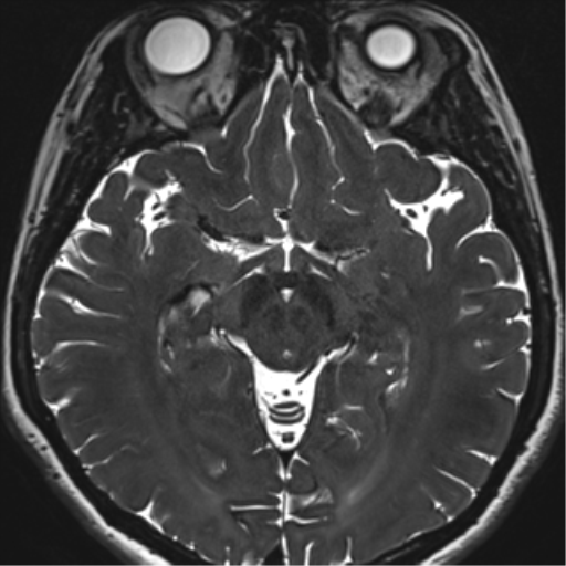 File:Abducens nerve palsy (Radiopaedia 51069-56648 Axial T2 fat sat 76).png
