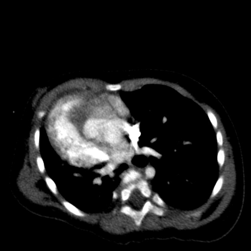 File:Aberrant left pulmonary artery (pulmonary sling) (Radiopaedia 42323-45435 Axial C+ CTPA 28).jpg