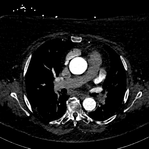 Aberrant right subclavian artery with Kommerell diverticulum (Radiopaedia 47982-52769 Axial C+ arterial phase 44).png
