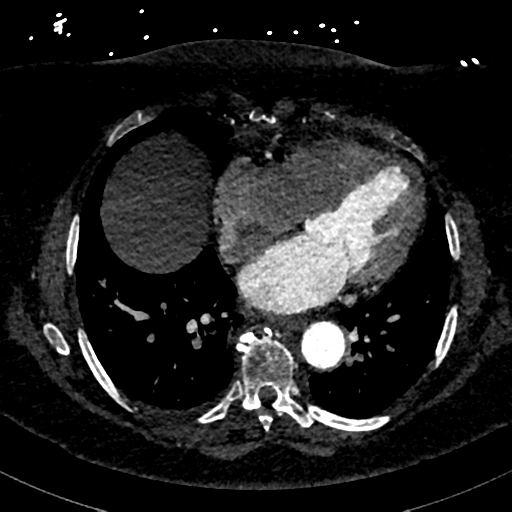 File:Aberrant right subclavian artery with Kommerell diverticulum (Radiopaedia 47982-52769 Axial C+ arterial phase 63).png
