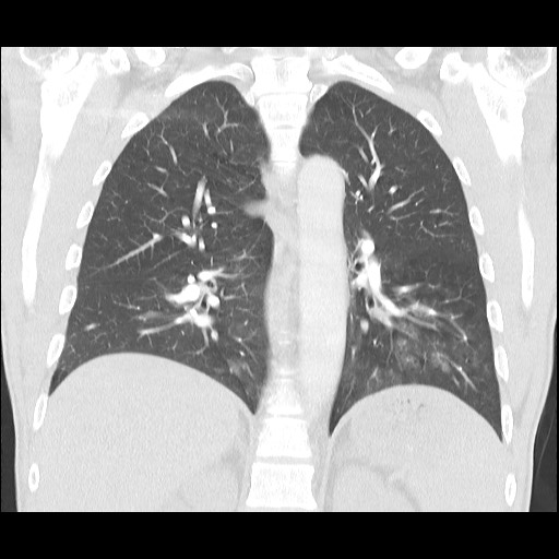 Accessory left horizontal fissure with lingular pneumonia (Radiopaedia 53763-59843 Coronal lung window 29).jpg