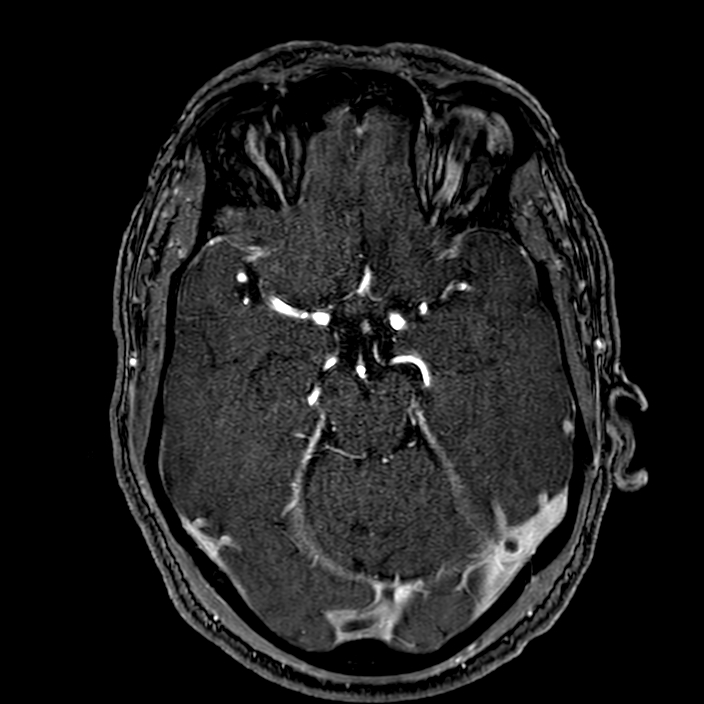 Accessory middle cerebral artery (Radiopaedia 73114-83828 Axial MRA 69).jpg