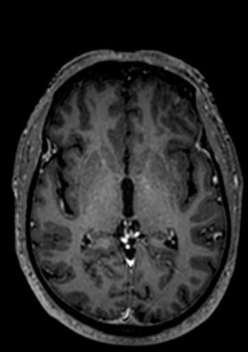 Accessory middle cerebral artery (Radiopaedia 73114-83828 Axial T1 C+ 38).jpg