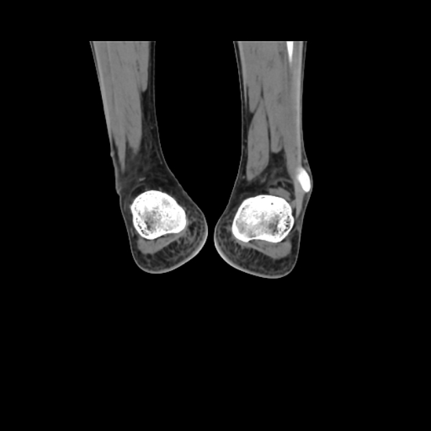 Accessory soleus muscle (Radiopaedia 61069-68943 Coronal non-contrast 61).jpg
