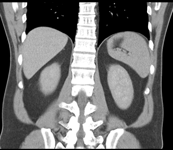 File:Achalasia of the cardia (Radiopaedia 38497-40595 Coronal C+ portal venous phase 38).png