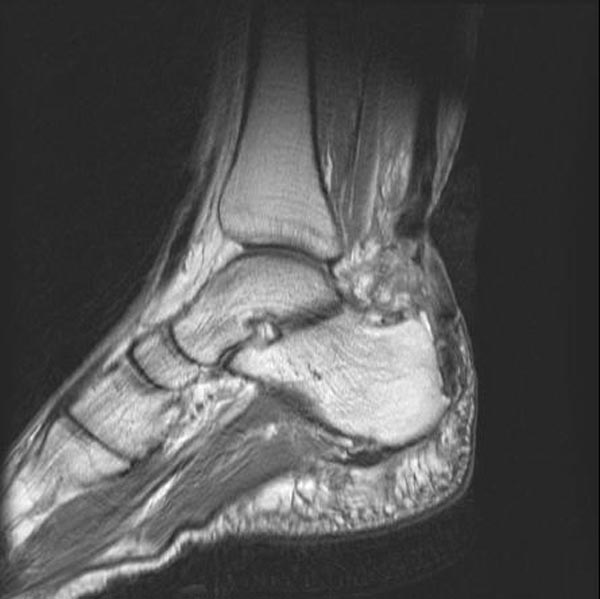File:Achilles tendon rupture (Radiopaedia 11159-11524 B 1).jpg