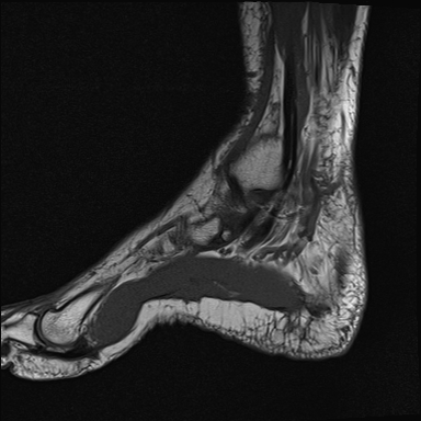 File:Achilles tendon tear (Radiopaedia 77615-89819 Sagittal T1 4).jpg