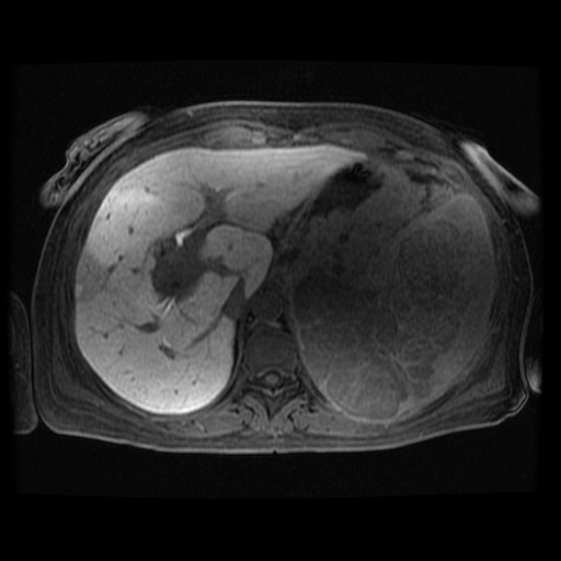 Acinar cell carcinoma of the pancreas (Radiopaedia 75442-86668 Axial late phase (~30 mins) 100).jpg