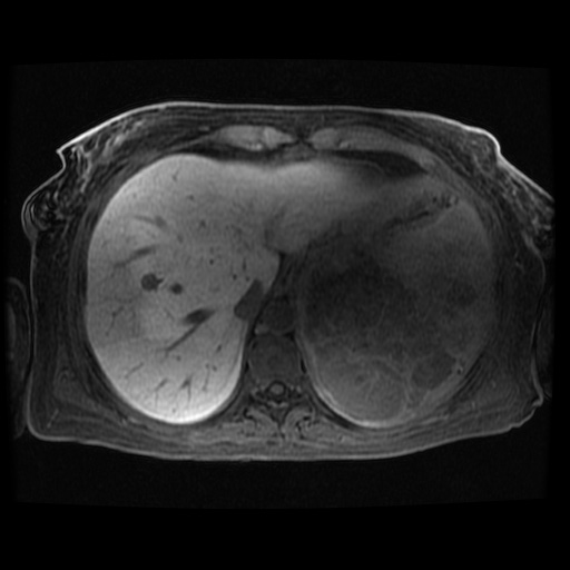Acinar cell carcinoma of the pancreas (Radiopaedia 75442-86668 Axial late phase (~30 mins) 115).jpg
