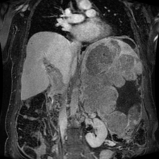 File:Acinar cell carcinoma of the pancreas (Radiopaedia 75442-86668 Coronal T1 C+ fat sat 96).jpg