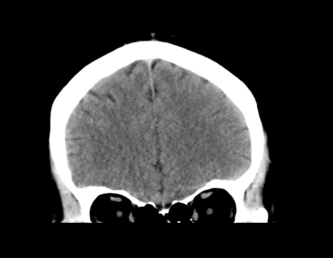 File:Acoustic schwannoma (Radiopaedia 33045-34065 Coronal non-contrast 14).png