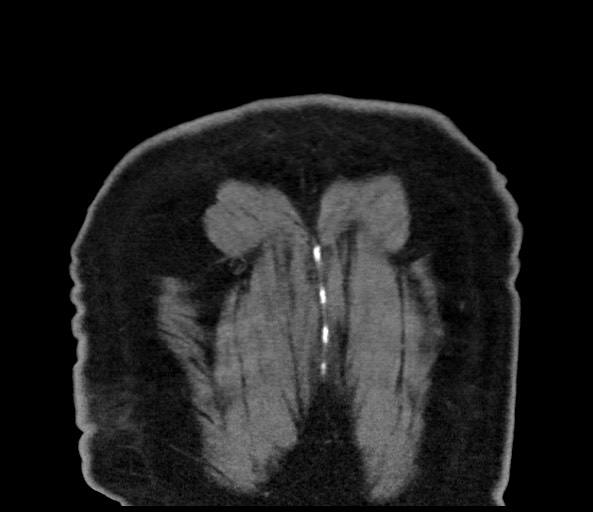 Acromioclavicular joint cyst (Radiopaedia 58455-65610 Coronal C+ arterial phase 135).jpg
