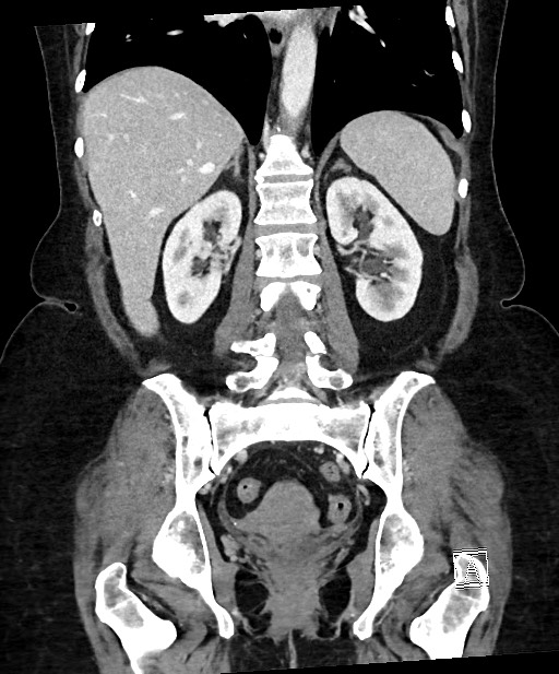 Active Crohn disease (Radiopaedia 59394-66750 Coronal C+ portal venous phase 47).jpg