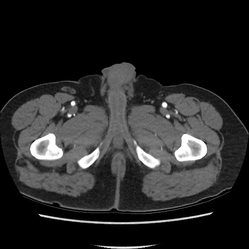 Active colonic bleed on CT (Radiopaedia 49765-55025 Axial C+ arterial phase 91).jpg