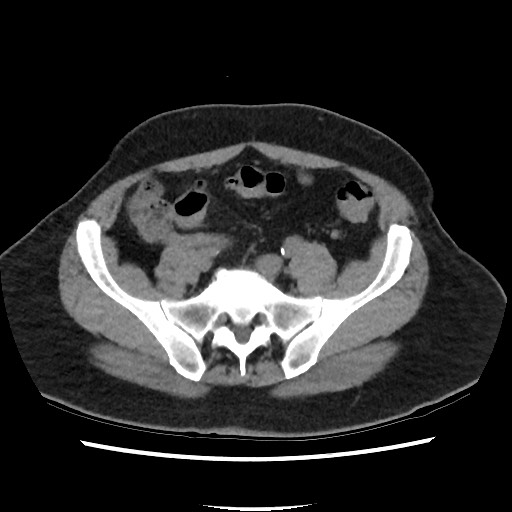 Active colonic bleed on CT (Radiopaedia 49765-55025 Axial non-contrast 61).jpg