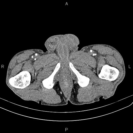 Active crohn disease (Radiopaedia 87133-103397 Axial C+ arterial phase 110).jpg