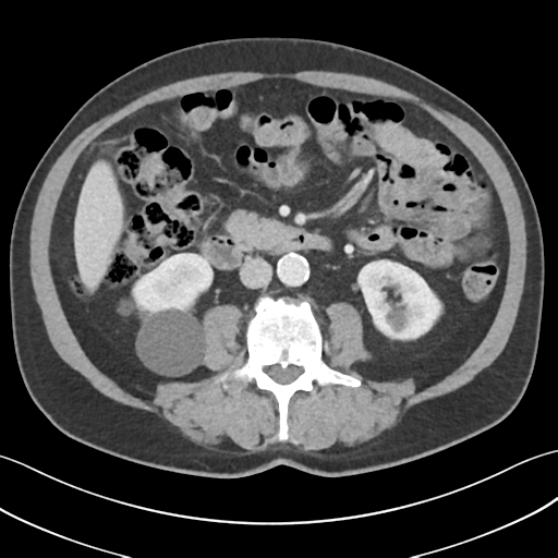 File:Active diverticular hemorrhage (Radiopaedia 39415-41725 Axial C+ portal venous phase 31).png