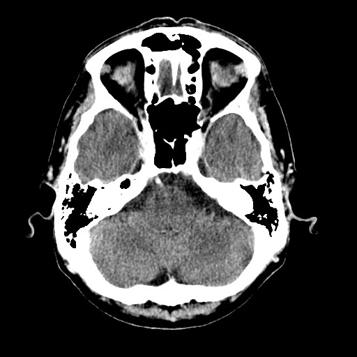 File:Active neurocysticercosis before and after therapy (Radiopaedia 71710-82099 Axial C+ delayed 80).jpg