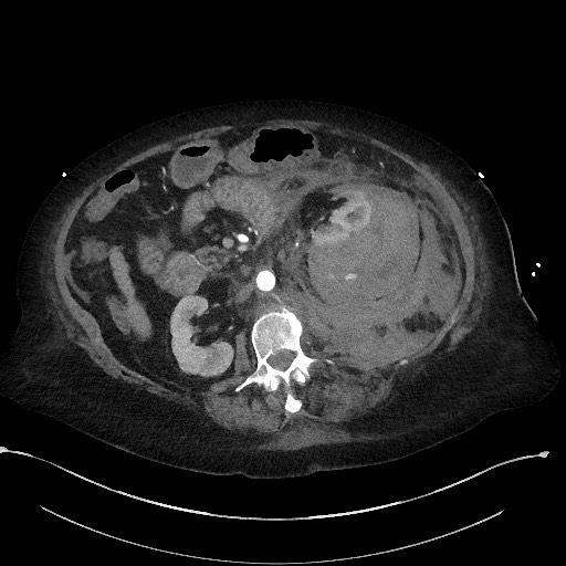 Active renal extravasation with large subcapsular and retroperitoneal hemorrhage (Radiopaedia 60975-68796 Axial C+ arterial phase 84).jpg