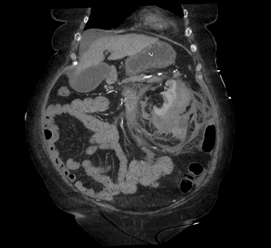 Active renal extravasation with large subcapsular and retroperitoneal hemorrhage (Radiopaedia 60975-68796 Coronal C+ arterial phase 50).jpg