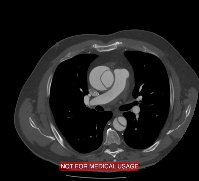 Acute aortic dissection - Stanford type A (Radiopaedia 40661-43285 Axial C+ arterial phase 25).jpg