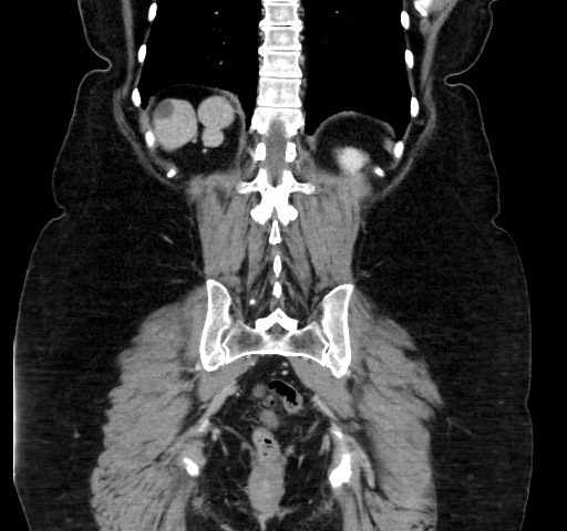 Acute appendicitis, heterotaxy syndrome (Radiopaedia 66884-76202 Coronal C+ portal venous phase 97).jpg