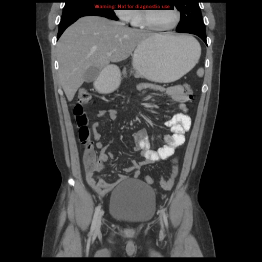 File:Acute appendicitis (Radiopaedia 10498-10973 F 6).jpg