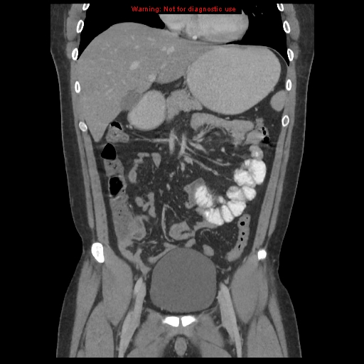 File:Acute appendicitis (Radiopaedia 10498-10973 F 8).jpg