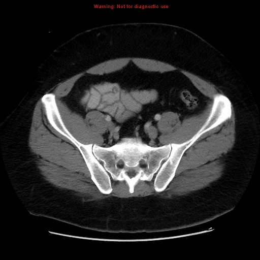 File:Acute appendicitis (Radiopaedia 12326-12607 Axial C+ portal venous phase 41).jpg
