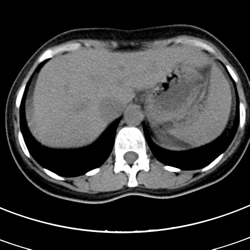 Acute appendicitis (Radiopaedia 30261-30888 Axial non-contrast 4).jpg