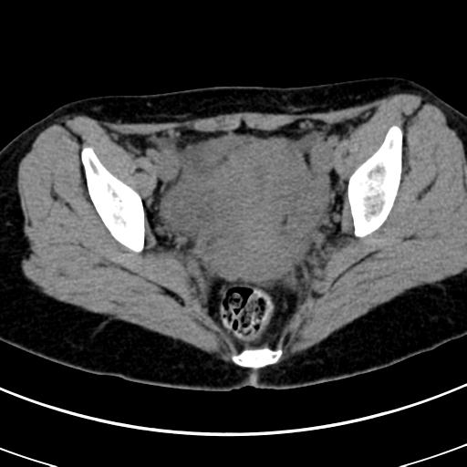 Acute appendicitis (Radiopaedia 30261-30888 Axial non-contrast 93).jpg