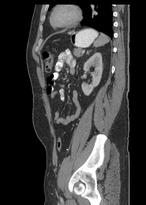 Acute appendicitis (Radiopaedia 48511-53463 Sagittal C+ portal venous phase 94).jpg