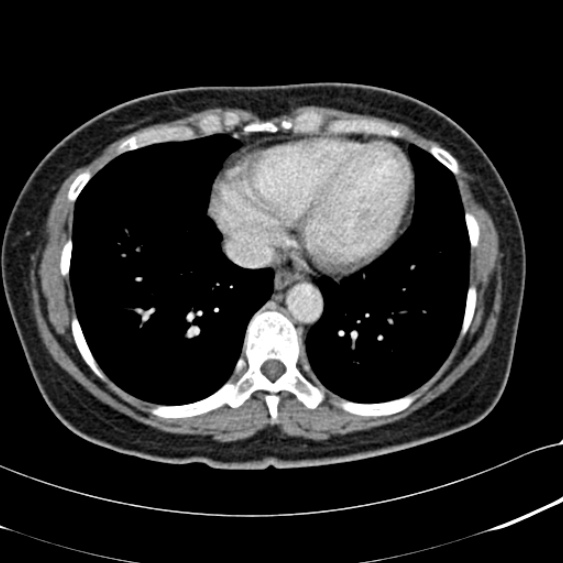 File:Acute appendicitis (Radiopaedia 48792-53822 Axial C+ portal venous phase 3).jpg
