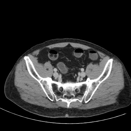 File:Acute appendicitis (Radiopaedia 66513-75790 Axial C+ portal venous phase 71).jpg