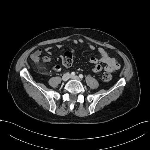 File:Acute appendicitis - large appendicoliths (Radiopaedia 61805-69820 Axial C+ portal venous phase 85).jpg