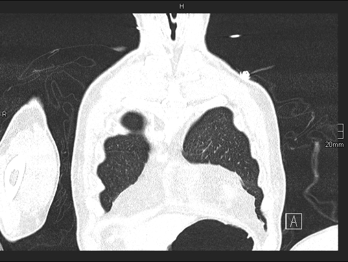 File:Acute aspiration pneumonitis (Radiopaedia 55642-62166 Coronal lung window 13).jpg