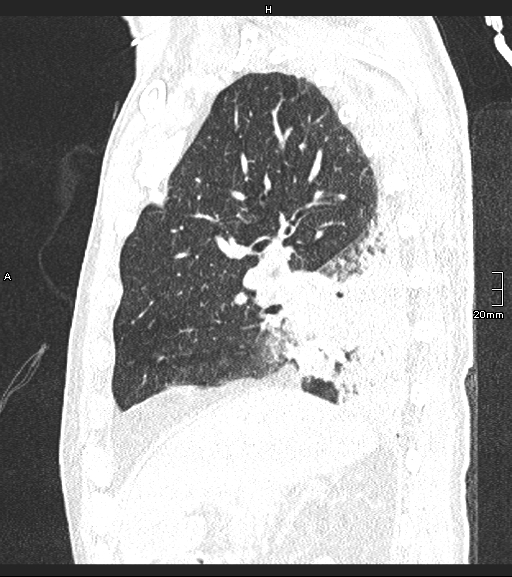 Acute aspiration pneumonitis (Radiopaedia 55642-62166 Sagittal lung window 102).jpg