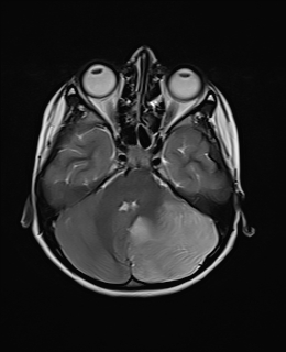 File:Acute cerebellar ataxia (Radiopaedia 61487-69446 Axial T2 6).jpg